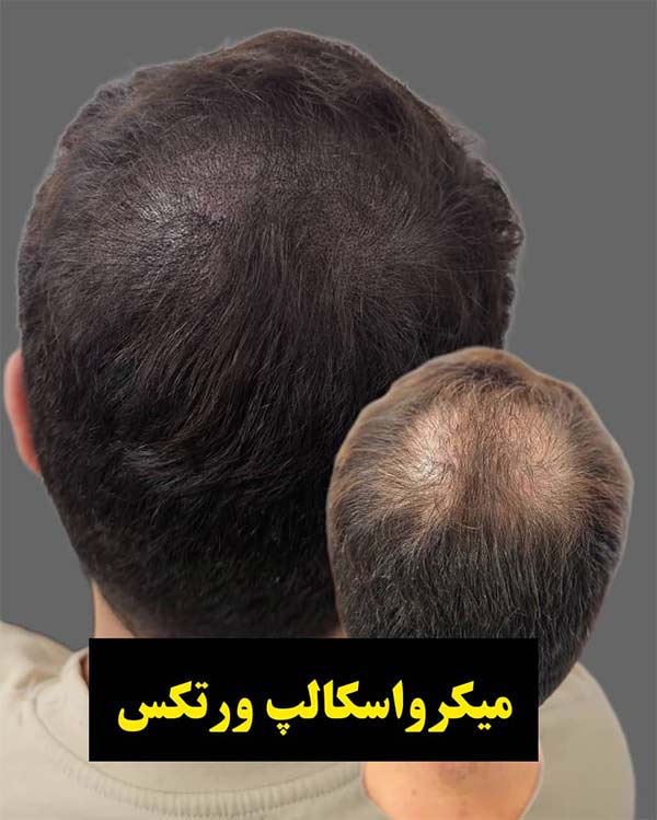 میکرو اسکالپ