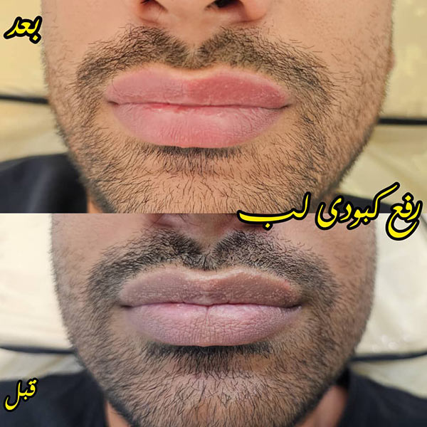 رفع کبودی لب در قزوین